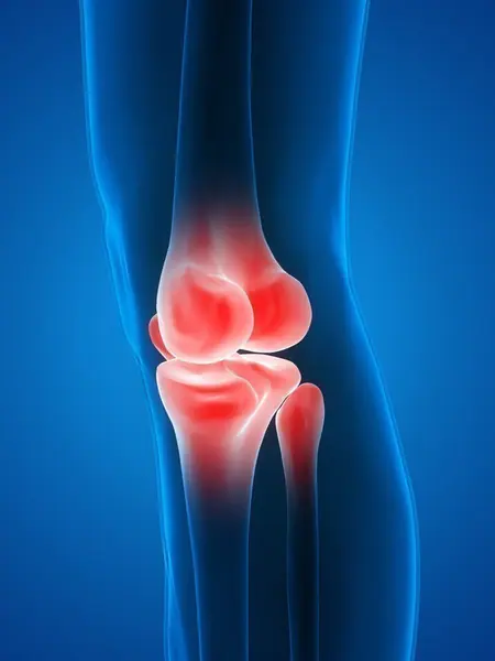 Dolor en la Rodilla